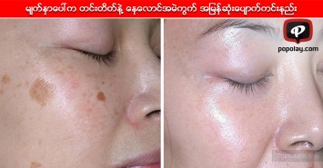 မျက်နှာပေါ်က တင်းတိတ်နဲ့ နေလောင်အမဲကွက် အမြန်ဆုံးပျောက်ကင်းနည်း