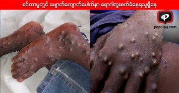 စင္ကာပူတြင္ ေမ်ာက္ေက်ာက္ေပါက္နာ ေရာဂါကူးစက္ခံေနရသူရွိေန