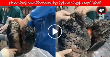 နှစ် ၃၀ လုံးလုံး ဆေးလိပ်တစ်နေ့တစ်ဗူး ပုံမှန်သောက်သူရဲ့ အဆုတ်(ရုပ်သံ)