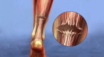 ဖနောင့်ကြောပြတ်ခြင်း (Achilles tendon rupture)